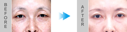 eyelid7_02 eyelid7_02