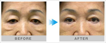 eyelid_7_8 eyelid_7_8