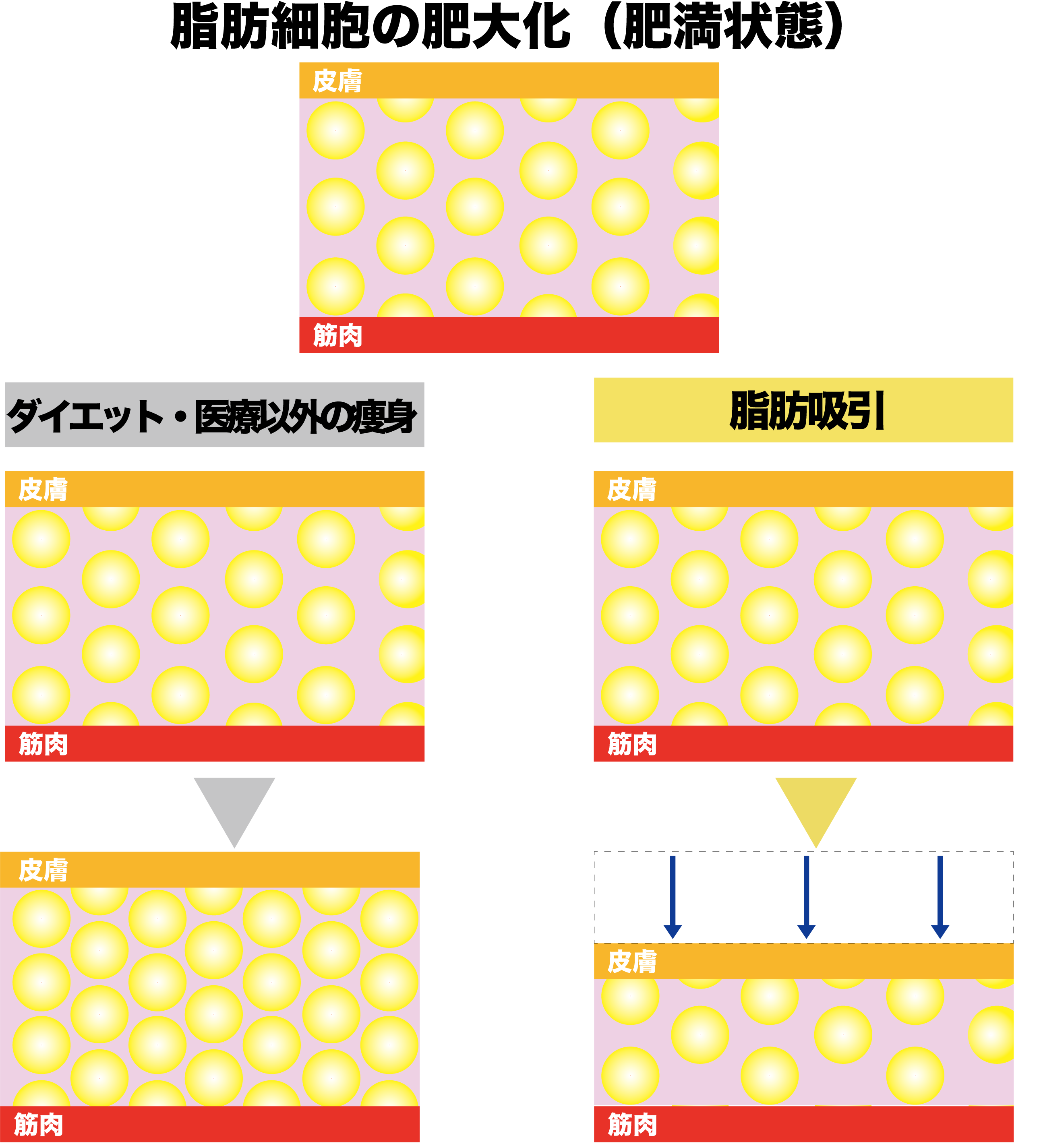 脂肪吸引LP画像2