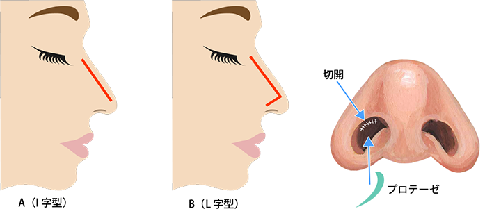 prosthesis_method