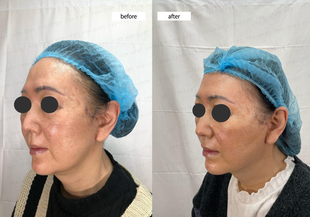 エイジングケアなら お任せください フェイスリフト-2 - 美容外科